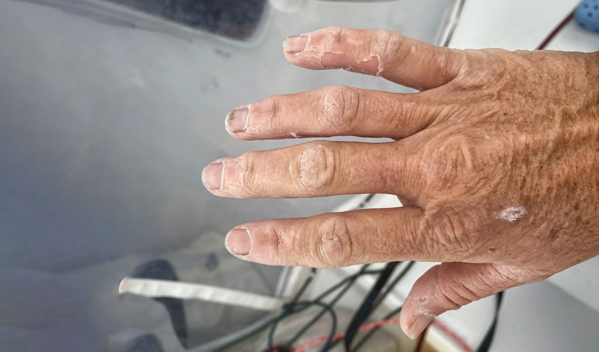 vendée globe blessure