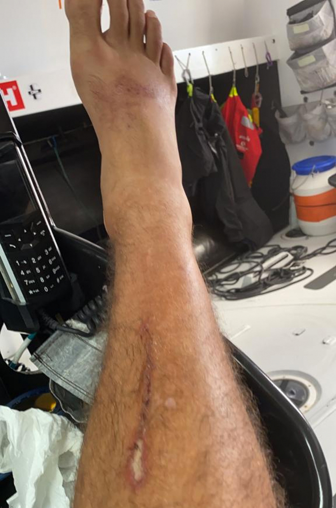 vendée globe blessure
