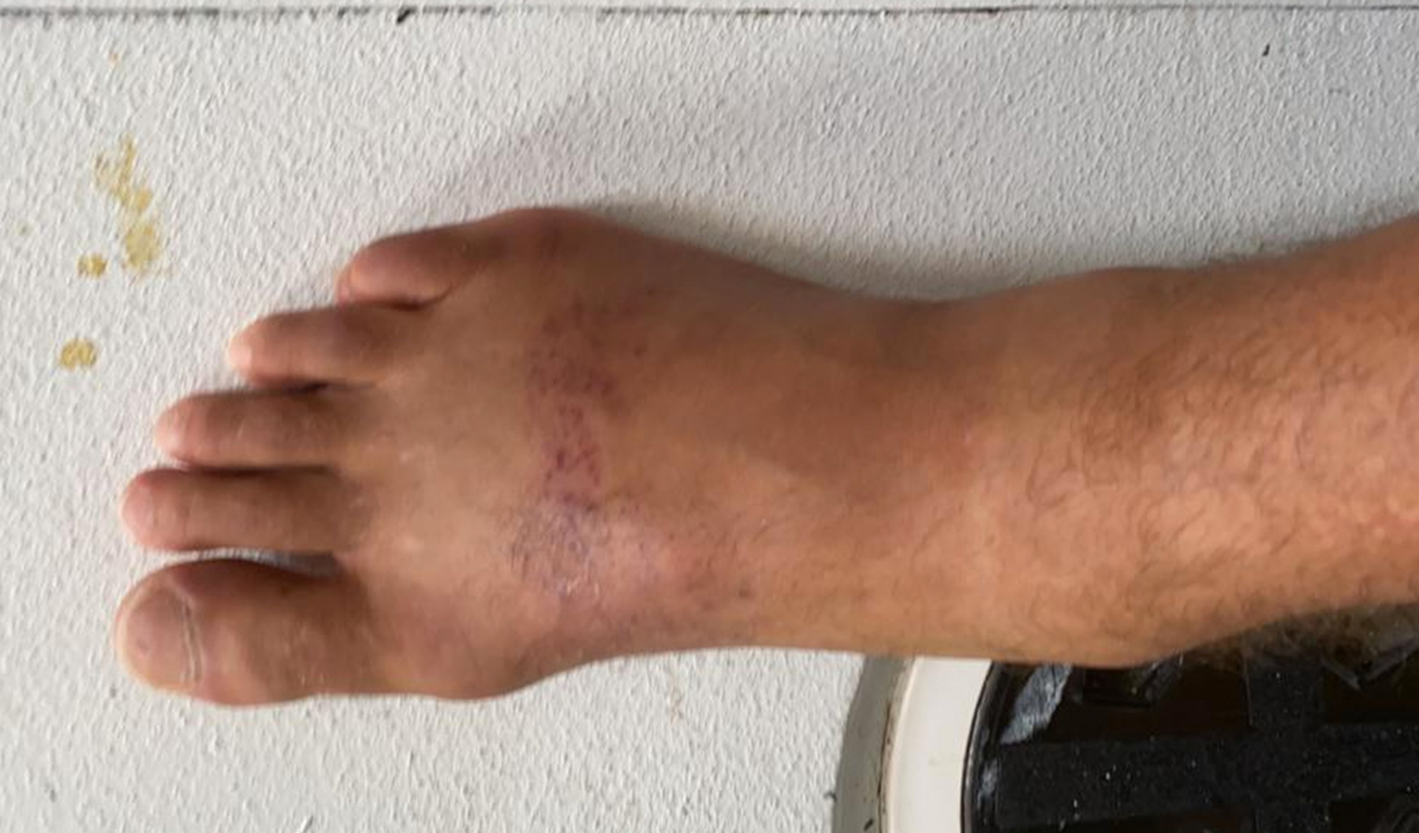 vendée globe blessure