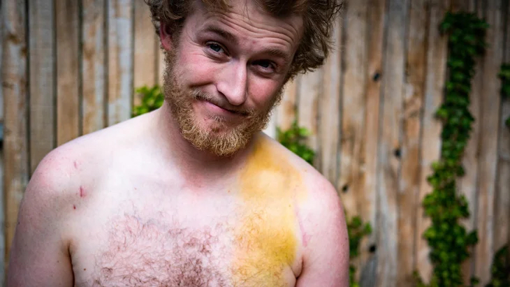 Drew Petersen juste après s'être cassé la clavicule.