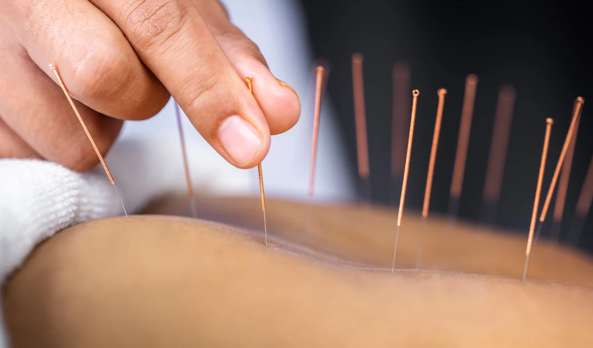 Acupuncture