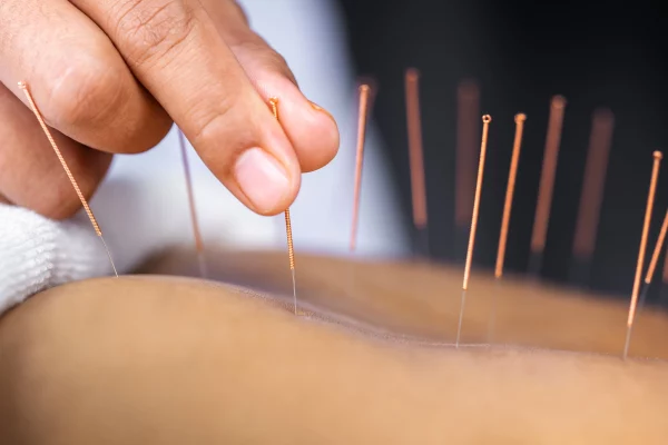 Acupuncture